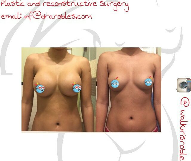 Breast Augmentation Example