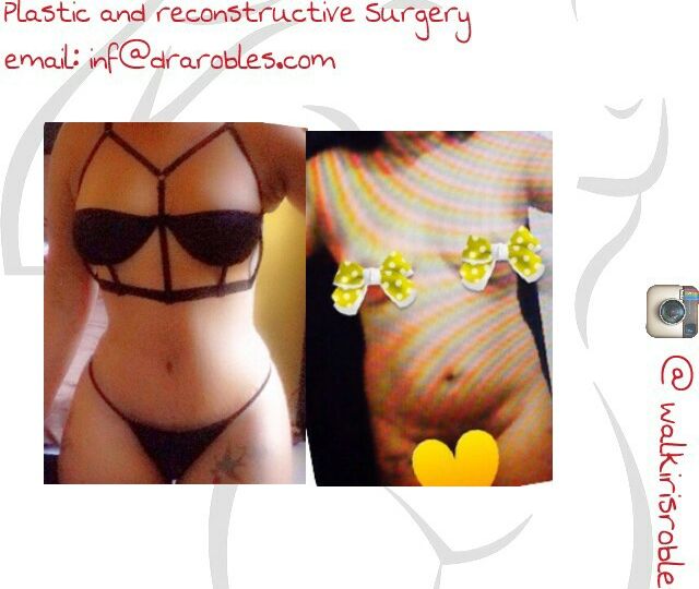 Breast Lift Example